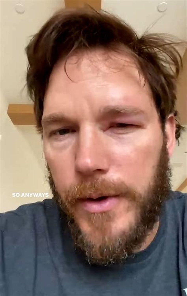 
“He thought this was a Marvel movie”: Chris Pratt trolled over eyelid bee sting on eye 