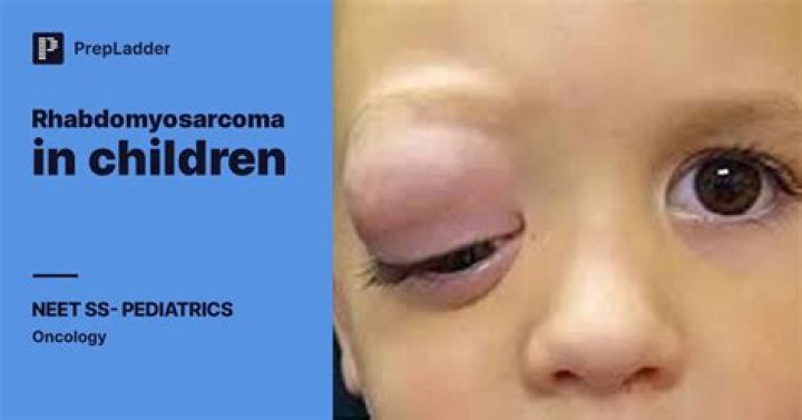 
Ryan Peniston And Rhabdomyosarcoma Eye Cancer Update, What Happened? 