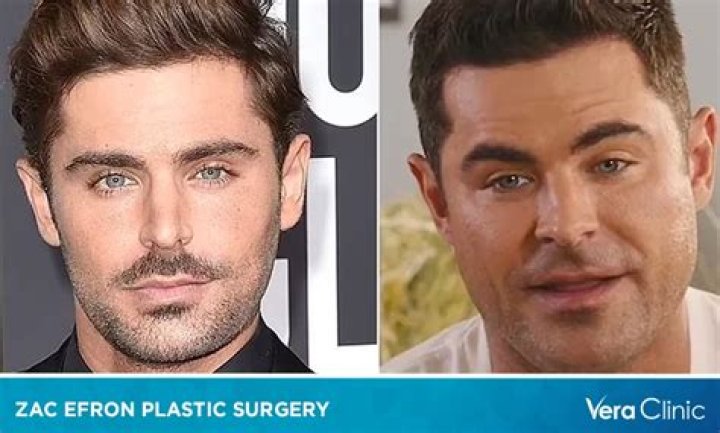 
What Did Zac Efron Do To His Face? Injury or Plastic Surgery, Why Did His Face Change? 