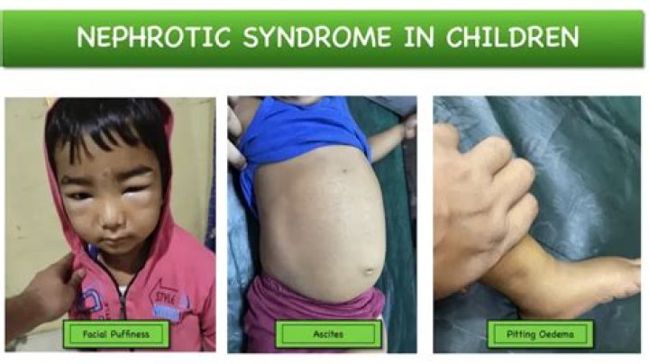 
What Illness Does Caito Potatoe Have? Health Issue Nephrotic Syndrome 
